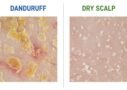 dandruff vs dry scalp